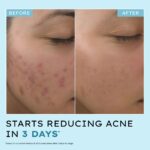 Hyphen Anti Acne 10% Azelaic Acid 2% Salicylic Acid Face Serum | 4% Niacinamide -Reduce Acne Marks, Fight Pimples | Tea Tree Extract -Soothes | Daily Serum for Women, Men | Oily, Acne Prone Skin -30ml - Image 5