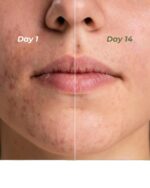 Indus Valley Calming Acne Gel with Seaweed Extract & Tea Tree Oil for Pimples, Soothes, Clarifies, and Refreshes Skin Naturally – 30ml - Image 8